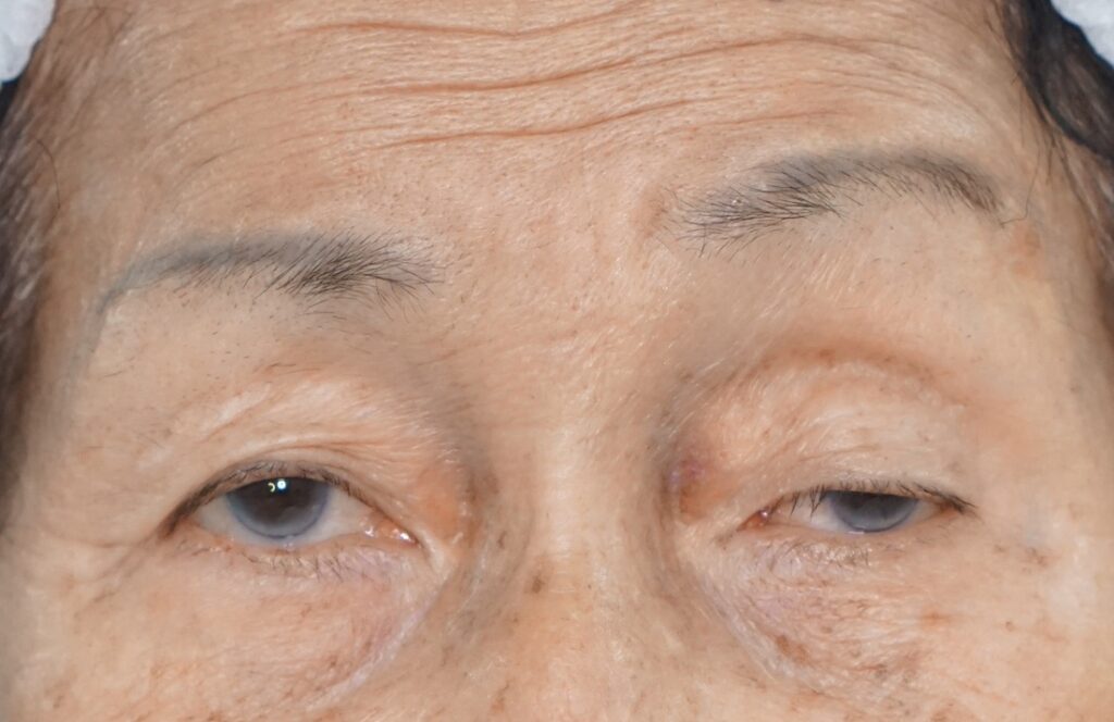 เปลือกตา, เปลือกตาตก, Aging Eyelids