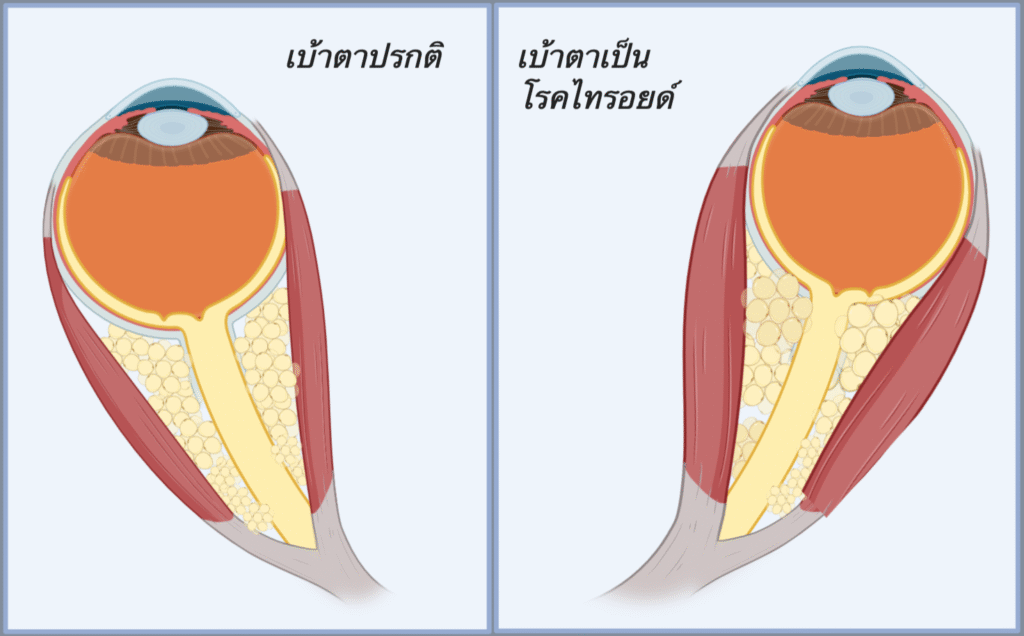 ไทรอยด์ขึ้นตา,ไทรอยด์เป็นพิษ, Thyroid Eye Disease