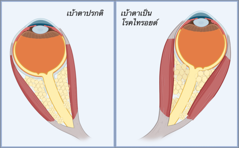 ไทรอยด์ขึ้นตา,ไทรอยด์เป็นพิษ, Thyroid Eye Disease