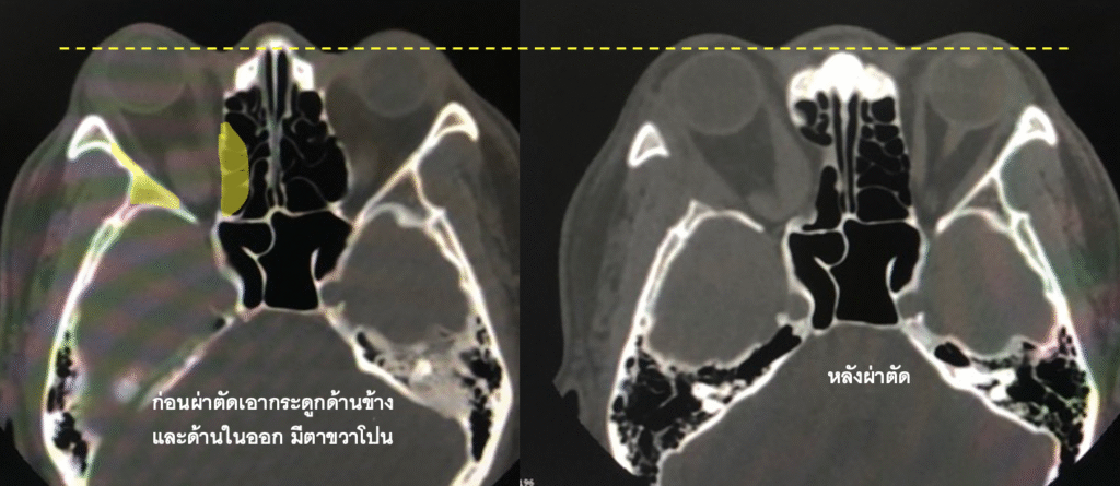 ไทรอยด์ขึ้นตา,ไทรอยด์เป็นพิษ